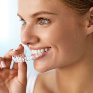 clear aligners