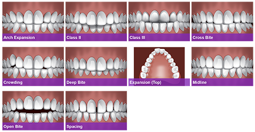 Clarity™ Aligners-Tampa FL|TLC Pediatric Dentistry & Orthodontics